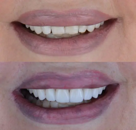 Before and after of a patient's smile with dental veneers placed in Tijuana.